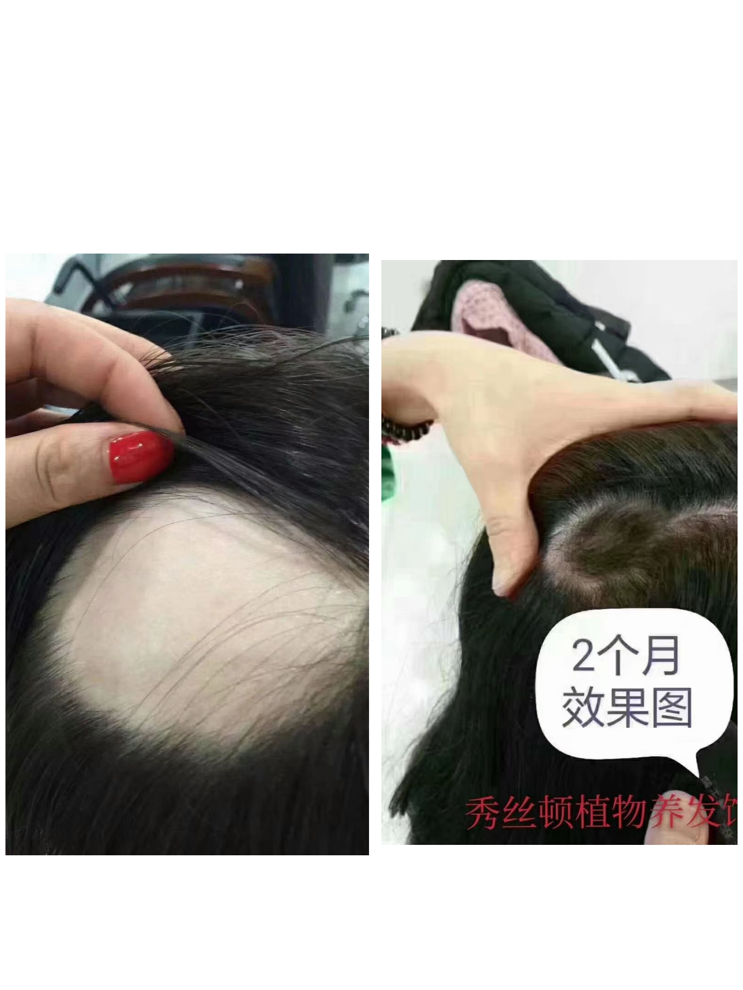 斑秃一次治愈