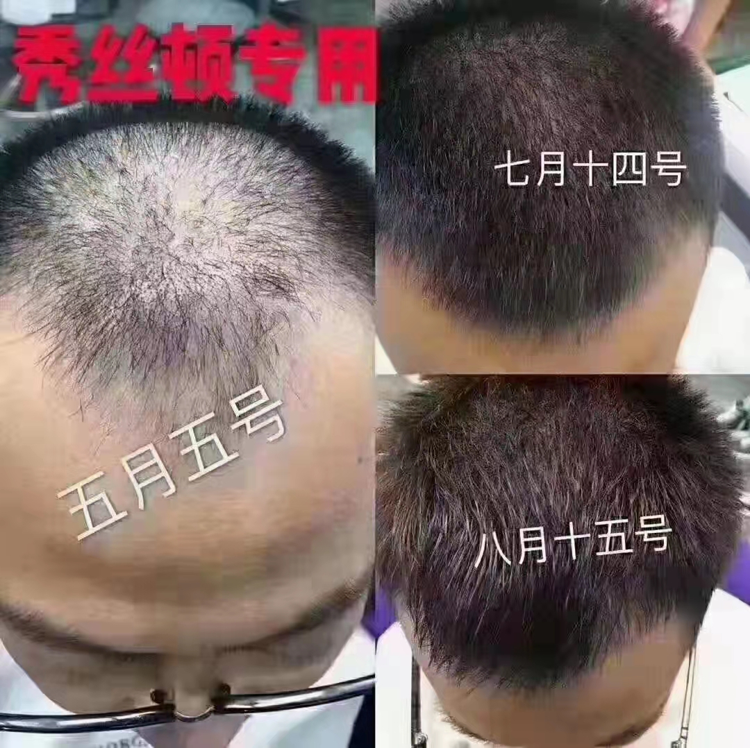 秀丝顿植物养发效果好安全健康