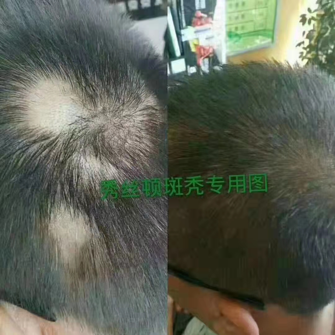 秀丝顿植物养发招商，代理加盟