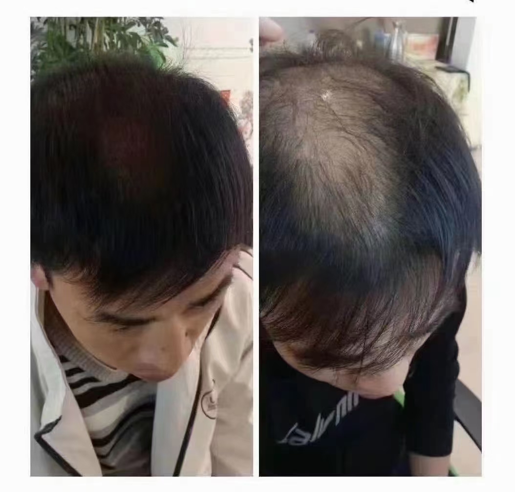 秀丝顿植物头疗防治老年痴呆、脑溢血和脑梗塞、中风后遗症