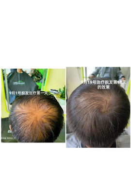 秀丝顿植物养发馆多种天然植物提取物，能够滋养头皮，刺激毛囊，增加发丝的养分供应
