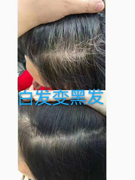 秀丝顿植物养发防脱，为你带来全新的生发、乌发、斑秃解决方案