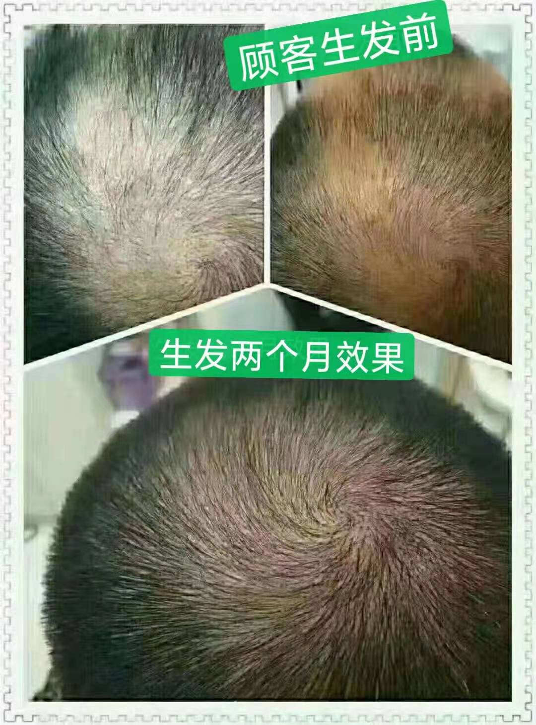 秀丝顿植物养发头部理疗首先用中草药清洗头皮，疏通毛囊，去除皮质栓塞，去除化学残留。