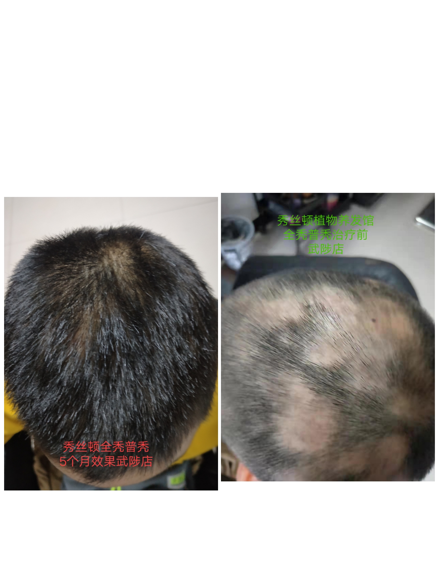 秀丝顿植物养发馆头疗采用传统手法进行学位按摩，梳疗改善睡眠质量，预防脱发，白发