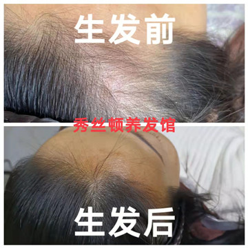 秀丝顿中药头疗改善头油大，头痒，脱发，乌发等功效