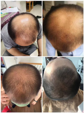 秀丝顿生发是一款非常受欢迎的生发产品