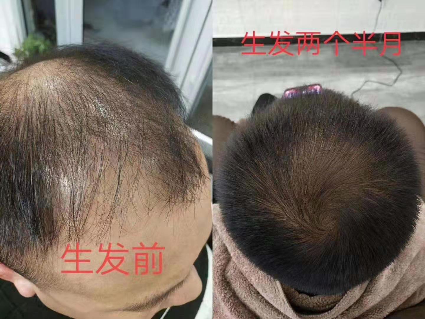 秀丝顿白发养黑”是一种安全、有效的改善白发的办法