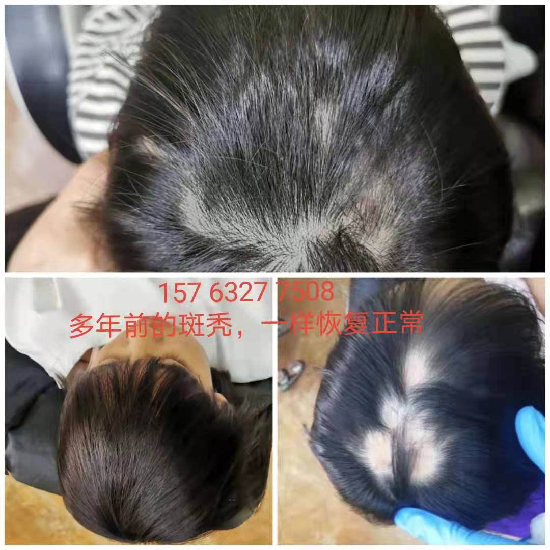 丝顿植物祛头油采用了天然植物提取物，不含硅油、矿物油等化学成分，非常安全可靠