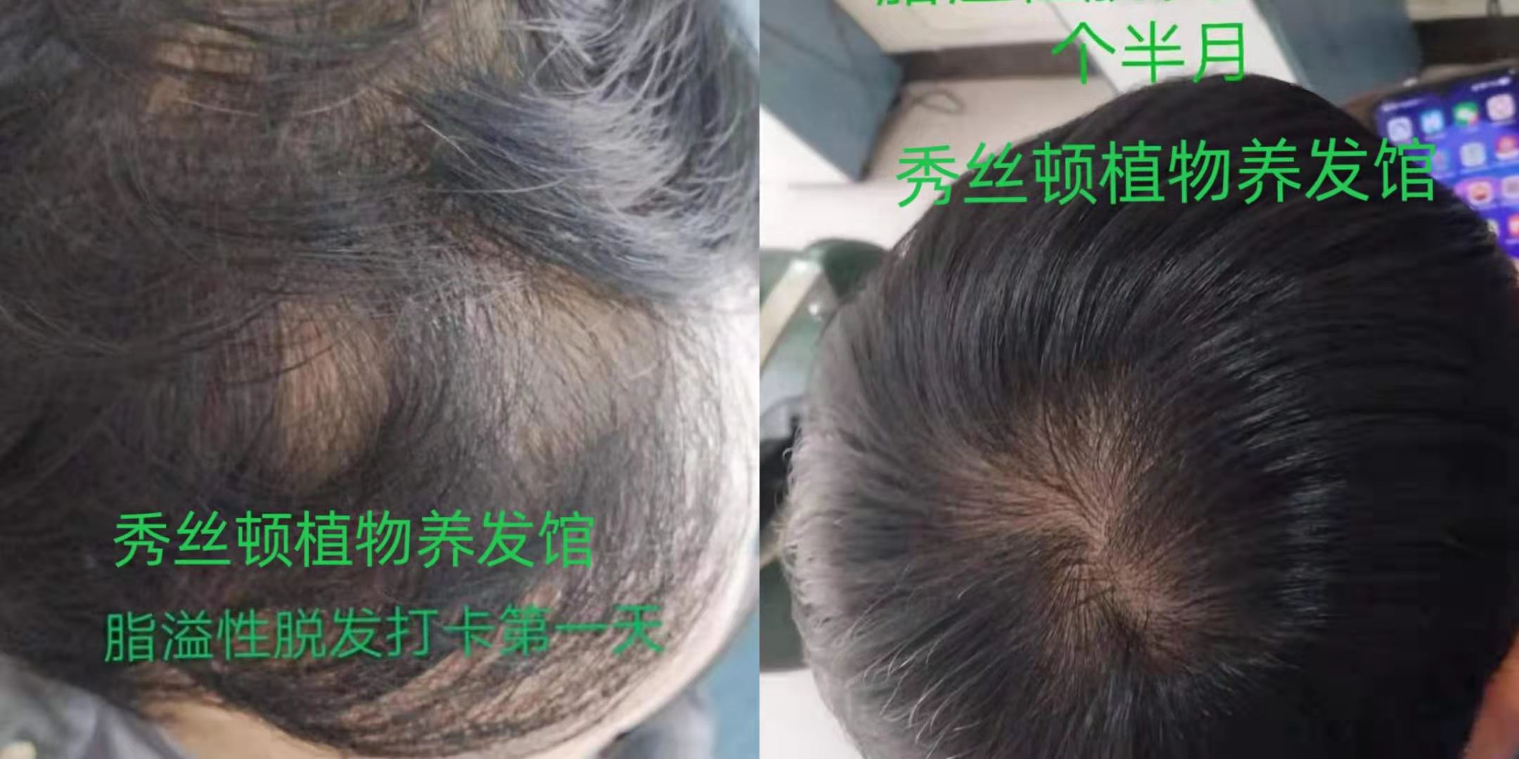 秀丝顿中药头疗采用20多种名贵中草药现场熬制泡头。加上专业按摩手法