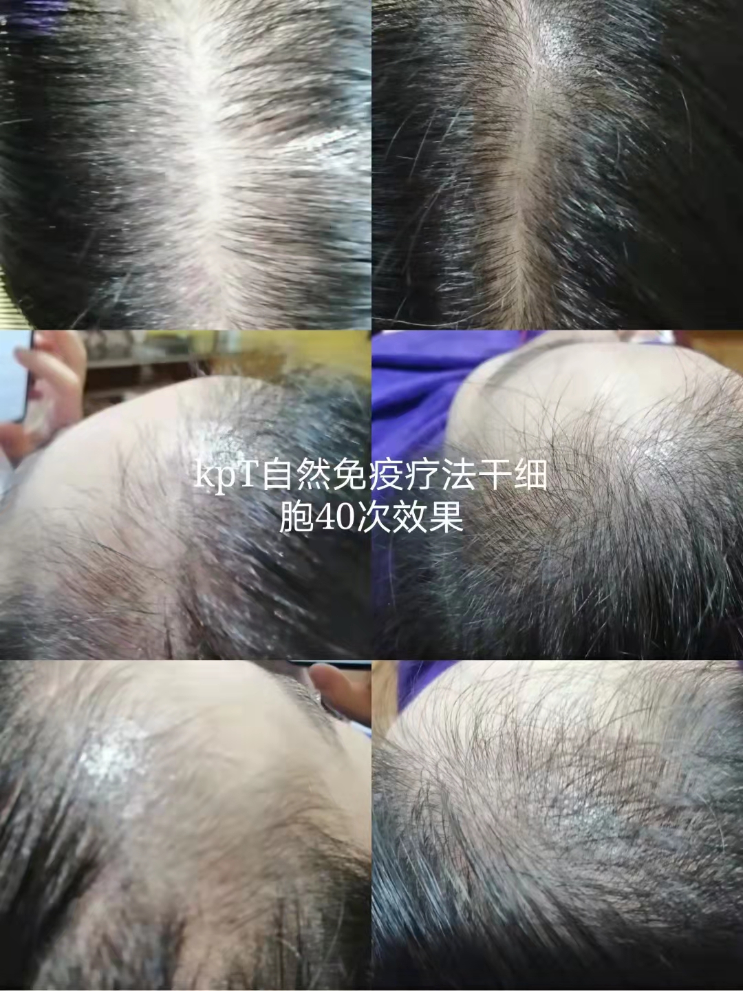 秀丝顿植物染发是一种100%天然的产品，使用植物提取物进行染发，不含有任何化学成分
