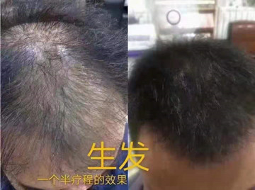 秀丝顿植物养发头部理疗首先用中草药清洗头皮，疏通毛囊，去除皮质栓塞，去除化学残留，营养毛囊，