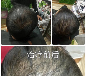秀丝顿头部理疗促进头部血液循环增加毛囊新陈代谢是细胞恢复年轻态，缓解脑部疲劳