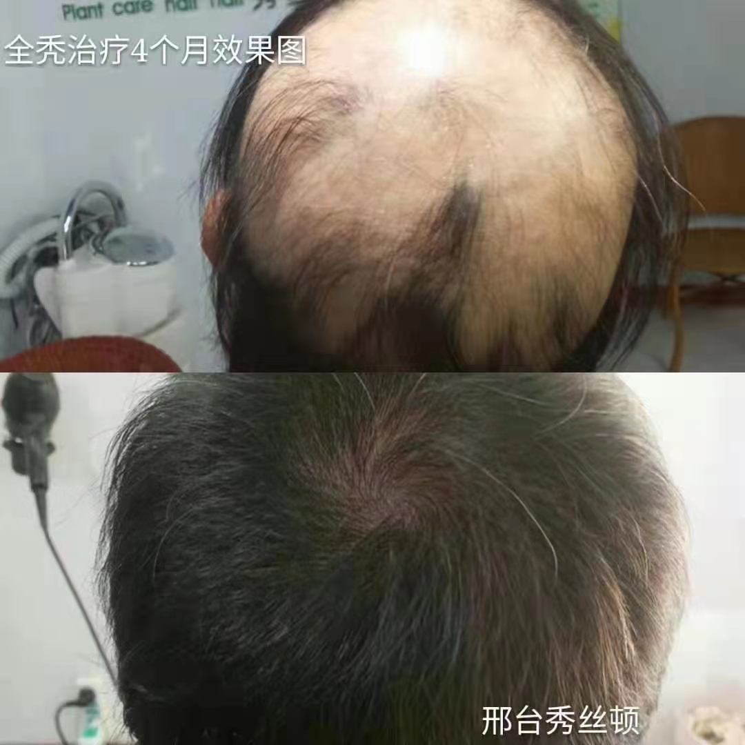 秀丝顿中药头疗采用20多种名贵中草药现场熬制泡头疏通经络，改善睡眠，偏头疼。神经衰弱等症