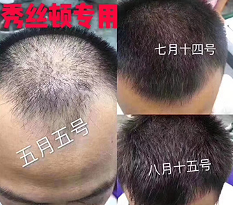 秀丝顿植物养发预防脱发，白发，促进新陈代谢，预防脑梗塞和老年痴呆。