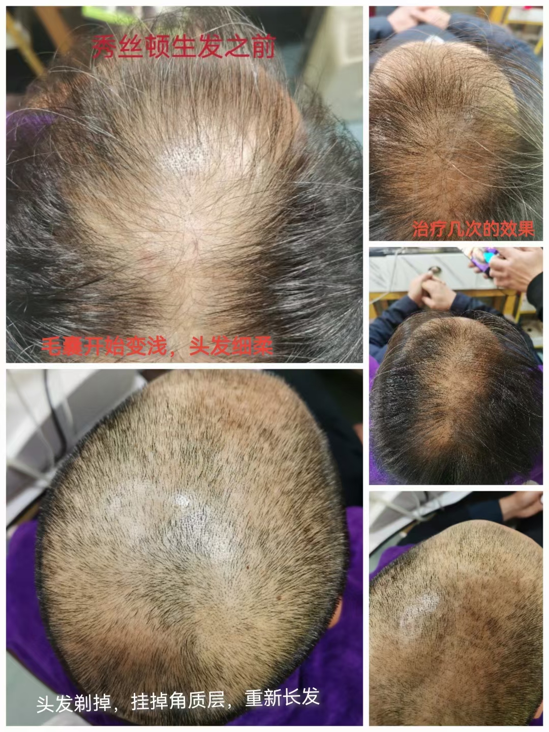 秀丝顿植物养发健康采用纯天然的植物成分，不含硅油、矿物油等化学成分