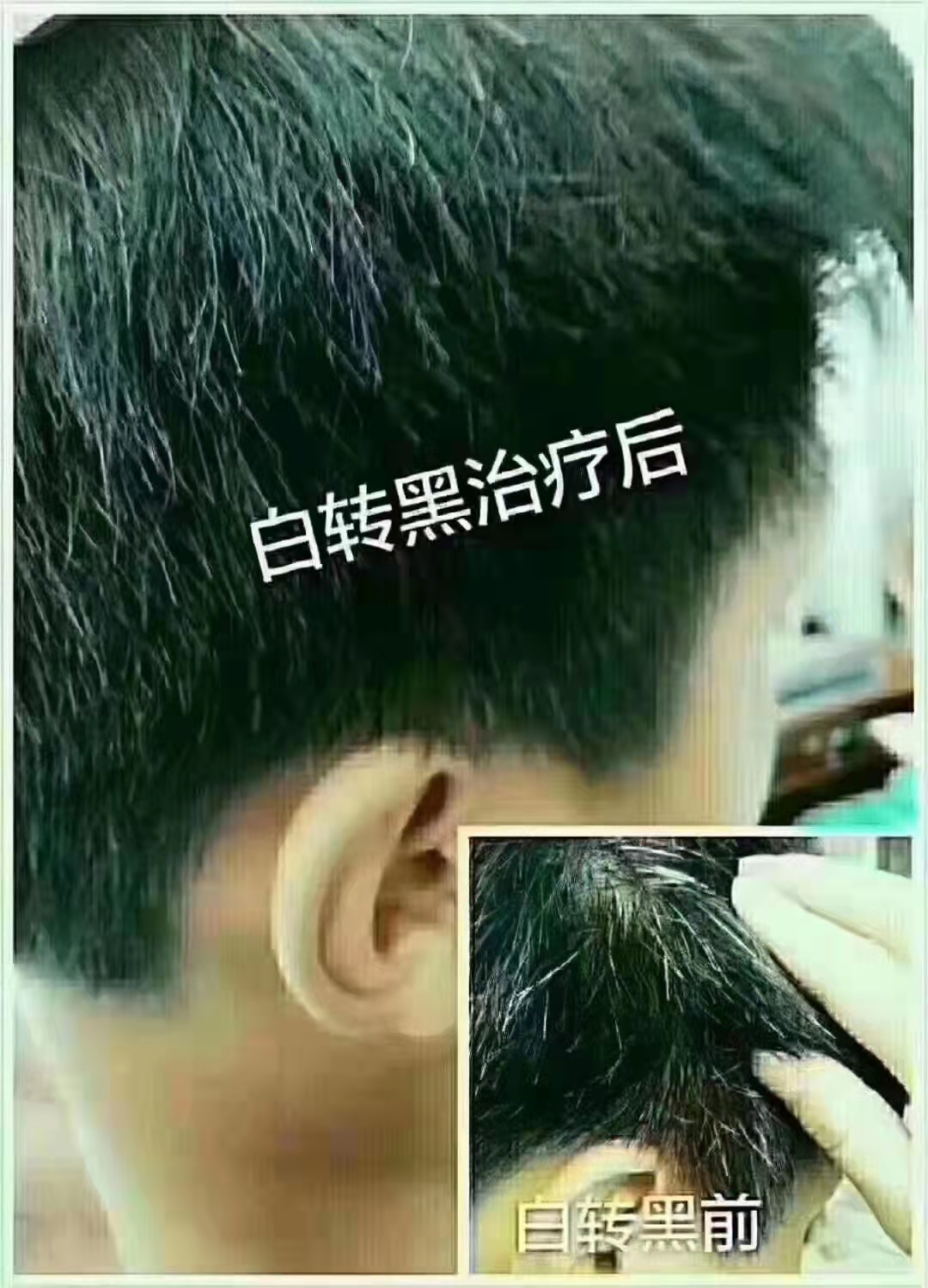 秀丝顿白发养黑”是一种安全、有效的改善白发