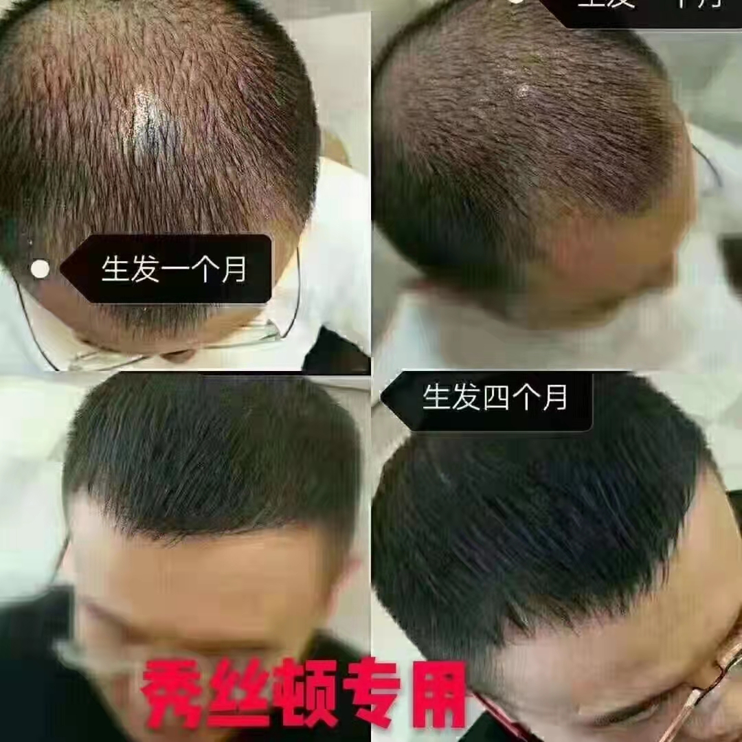 来秀丝顿植物养发馆试试中药制剂吧！让我们一起告别白发，焕发青春！