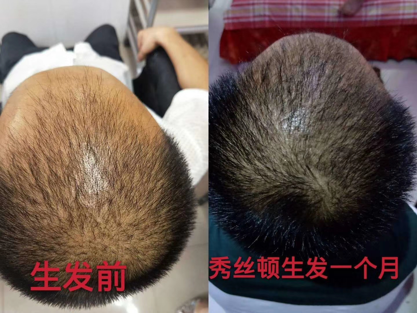 秀丝顿植物染发的优点在于它不含有害化学物质，不会对头发和身体造成伤害