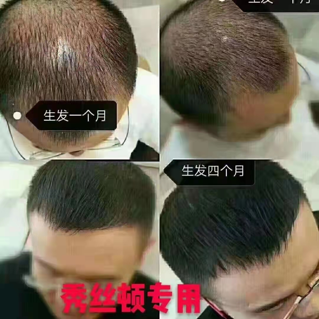 秀丝顿植物防脱产品更加安全、温和，不会对头皮和头发造成伤害