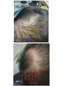 秀丝顿中药头疗改善头油大，头痒，脱发，乌发等功效。