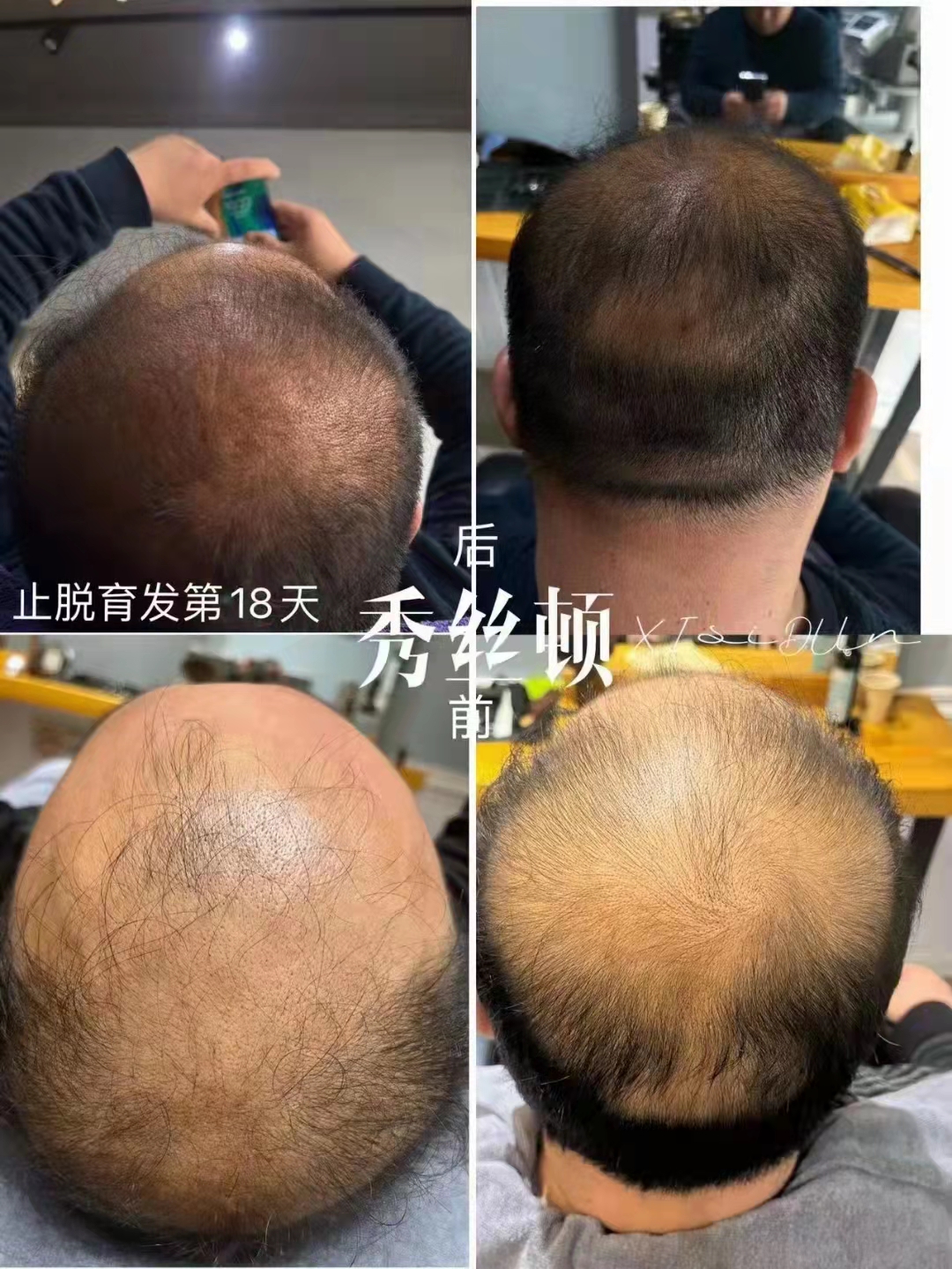 秀丝顿植物养发采用天然的植物提取物，促进头发生长，让你的头发更加浓密