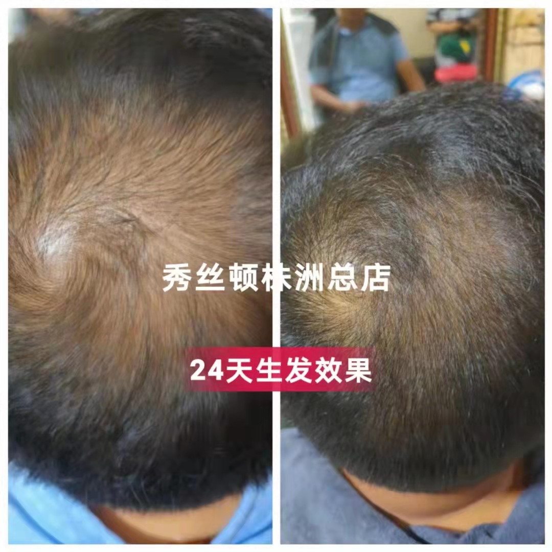 秀丝顿头疗，、防治老年痴呆、脑溢血和脑梗塞、中风后遗症、提升免疫力