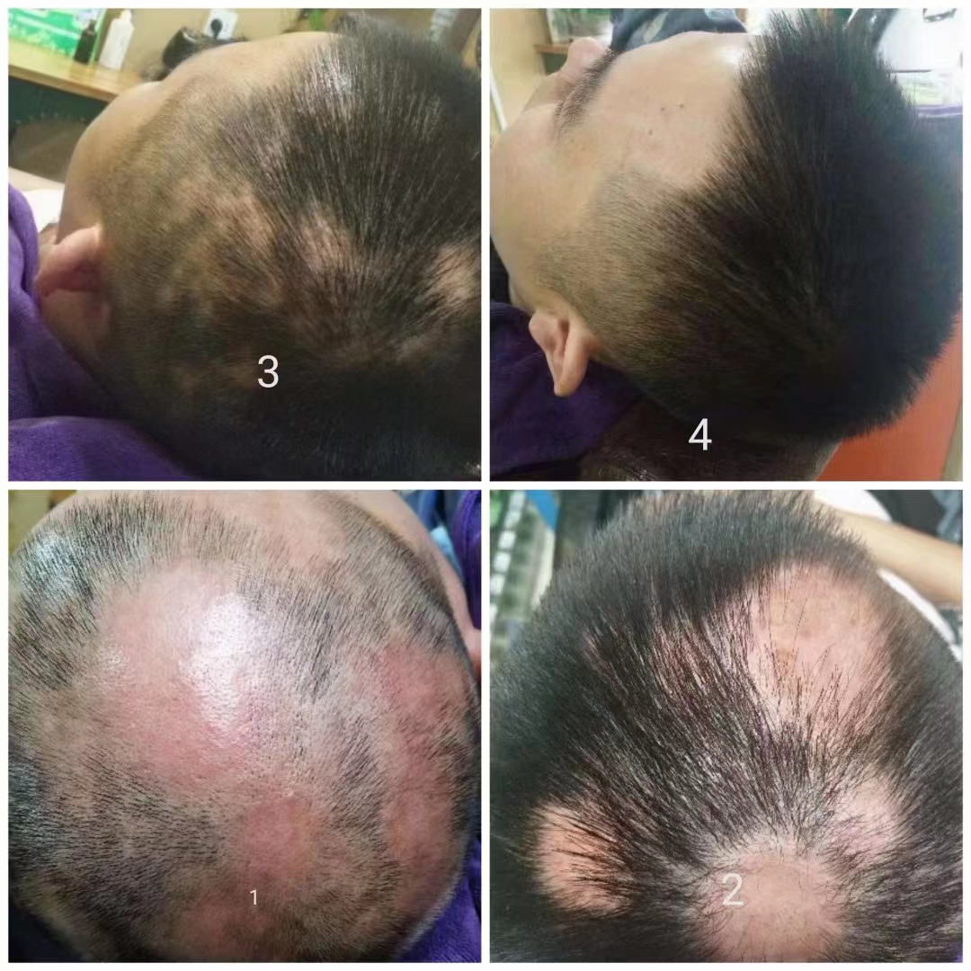 秀丝顿植物养发馆防脱、止脱、养发、生发、防白发、乌黑、控油、去屑、