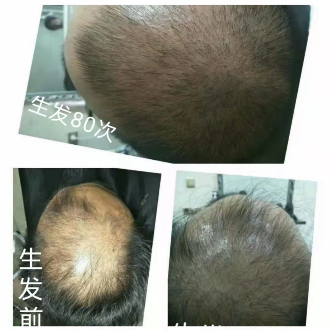 秀丝顿植物养发的优势在于其天然、安全、不刺激，